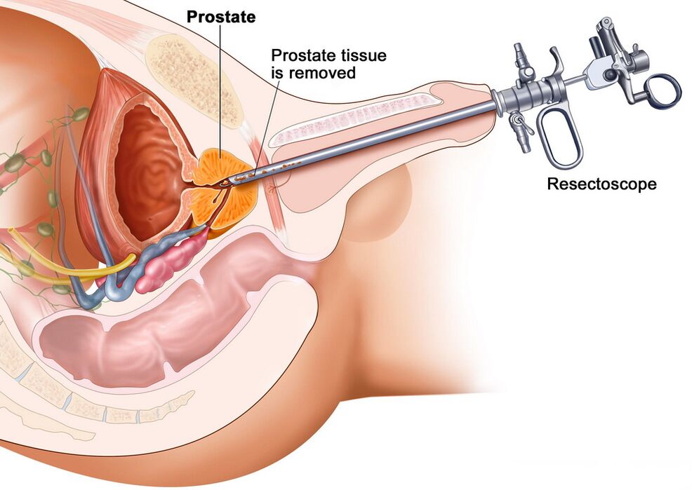 Prostatako ehun bilketa prostatitisaren diagnostiko zehatza egiteko