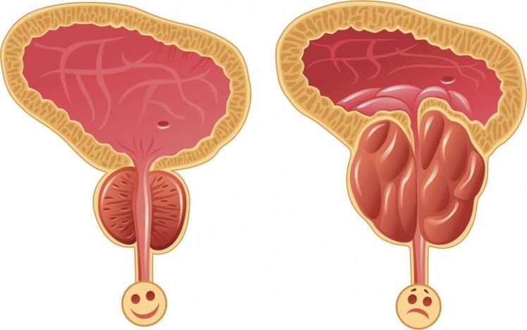 Prostata osasuntsua eta prostatitisa